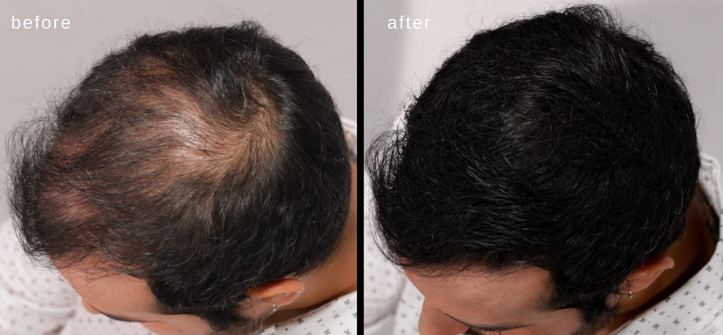 LUXE Hair Building Fibers for Thinning Hair – Dark Brown – Thickening Fibers, Hypoallergenic, Dermatologist Tested, 2+ Month Supply