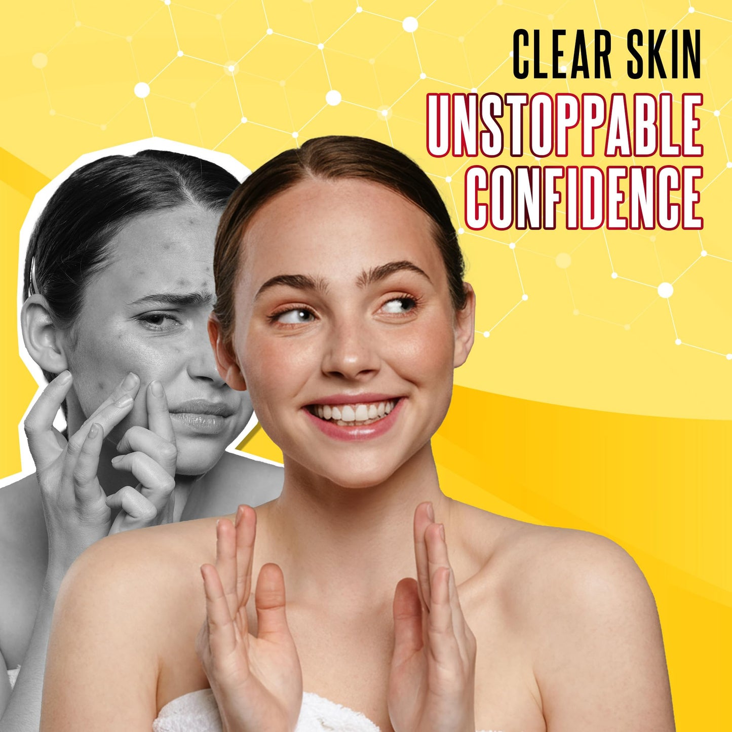 Biosulfur Grisi Acne Treatment Soap – Deep Cleansing Sulfur Bar, Fights Acne, Reduces Inflammation, Controls Oil & Blackheads, 4.4oz, 3-Pack