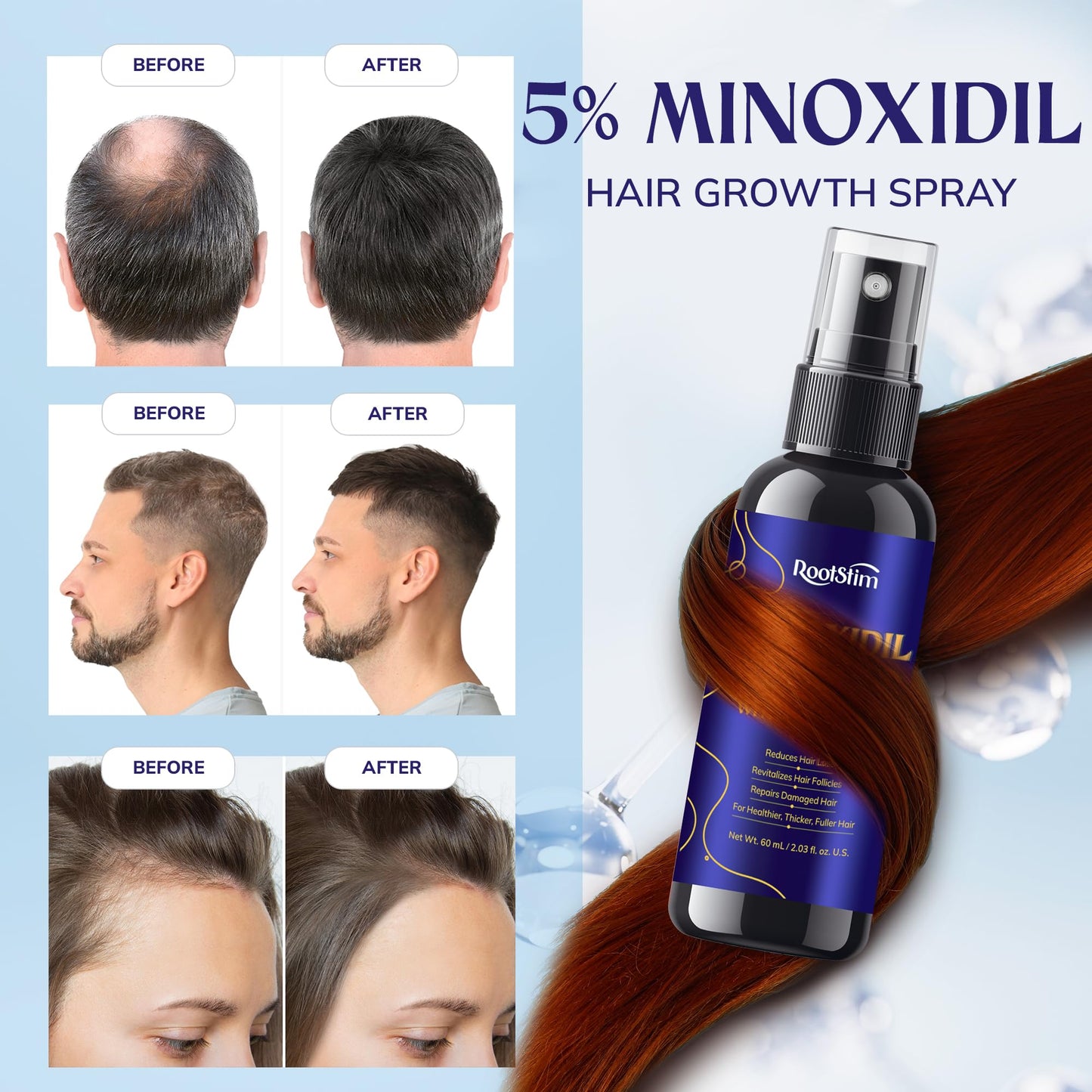 5% Minoxidil Hair Growth Serum for Men & Women – Extra Strength Hair Loss Treatment with Rosemary for Thicker, Stronger, Faster Hair Growth, 60ML