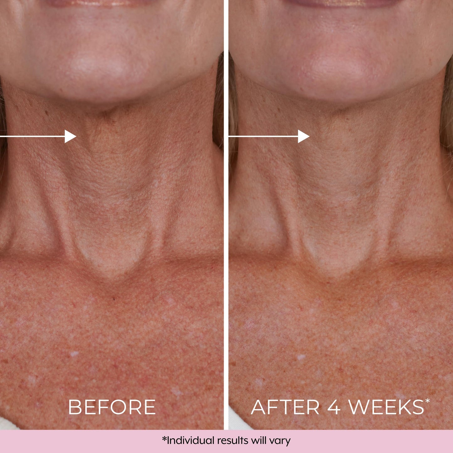 DEKLIDERM Neck Firming Cream – Anti Aging Retinol Cream Visibly Reduces Neck Wrinkles and Sagging – Neck Cream for loss of Firmness