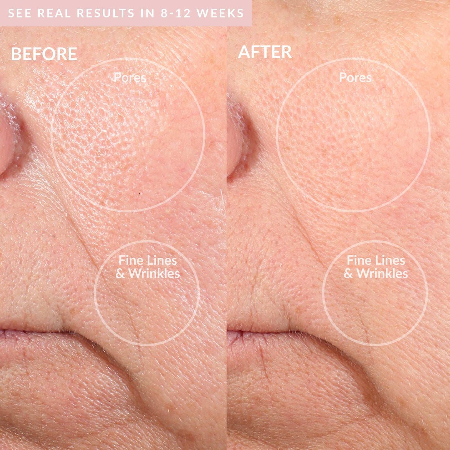 PMD Personal Microderm Pro - At-Home Microdermabrasion Device for Face & Body with Exfoliating Crystals, Vacuum Suction & Dual Speeds