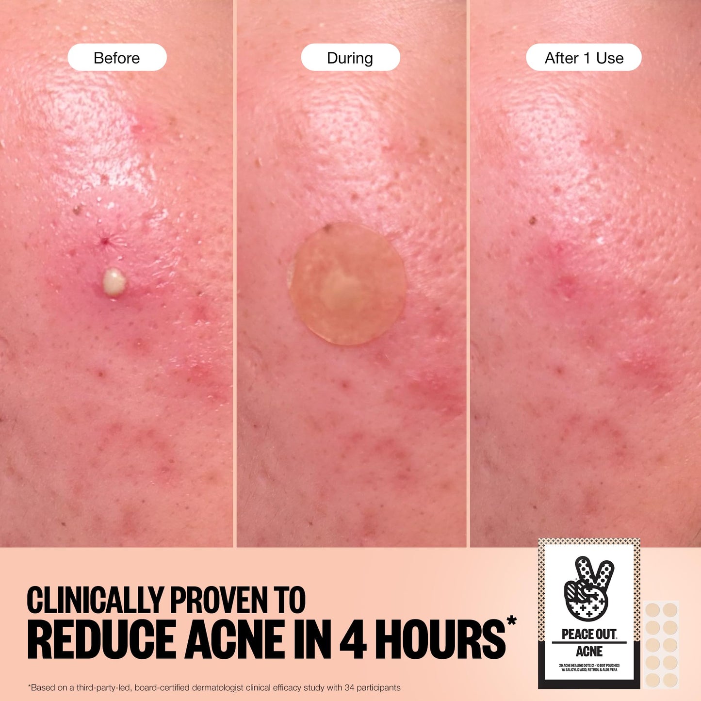 PEACE OUT Acne Healing Dots – Fast-Acting Pimple Patches with Salicylic Acid, Retinol & Aloe Vera, Clears Blemishes Overnight, 40ct