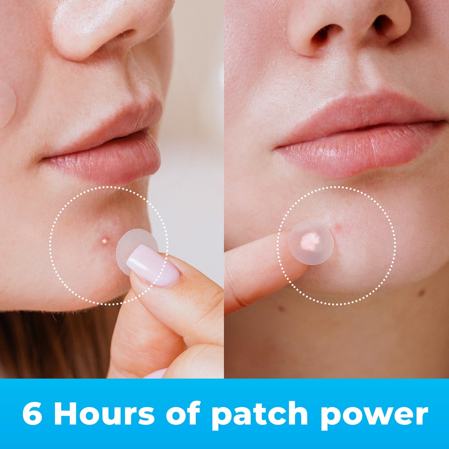 PatchRx Hydrocolloid Pimple Patches for Face (120) with Tea Tree Oil – Acne Dots & Zit Stickers for Clear Skin