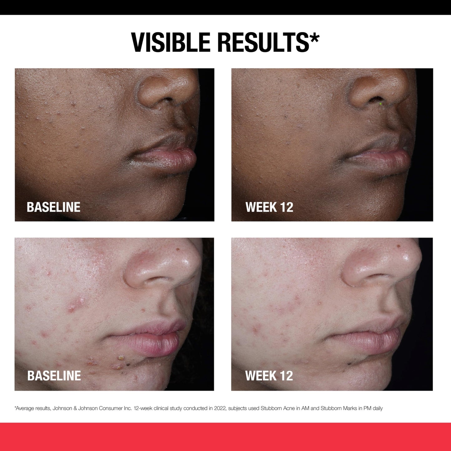 Neutrogena Retinol SA PM Treatment for Stubborn Marks – Exfoliates & Helps Fade Post-Acne Marks, Uneven Skin Tone, Unscented, 1 oz