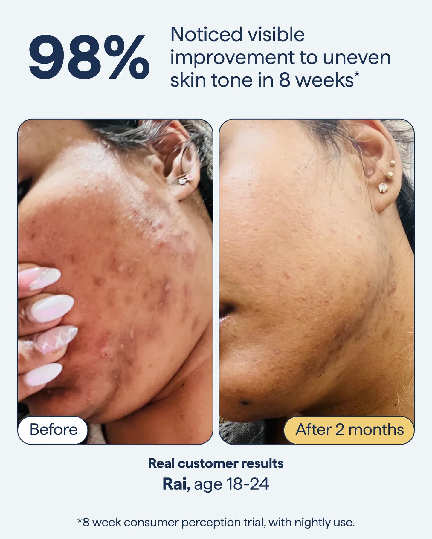 Remedy for Dark Spots – Face Discoloration Treatment with Retinol, Glutathione, Niacinamide, Mandelic & Kojic Acid by Dr. Shah