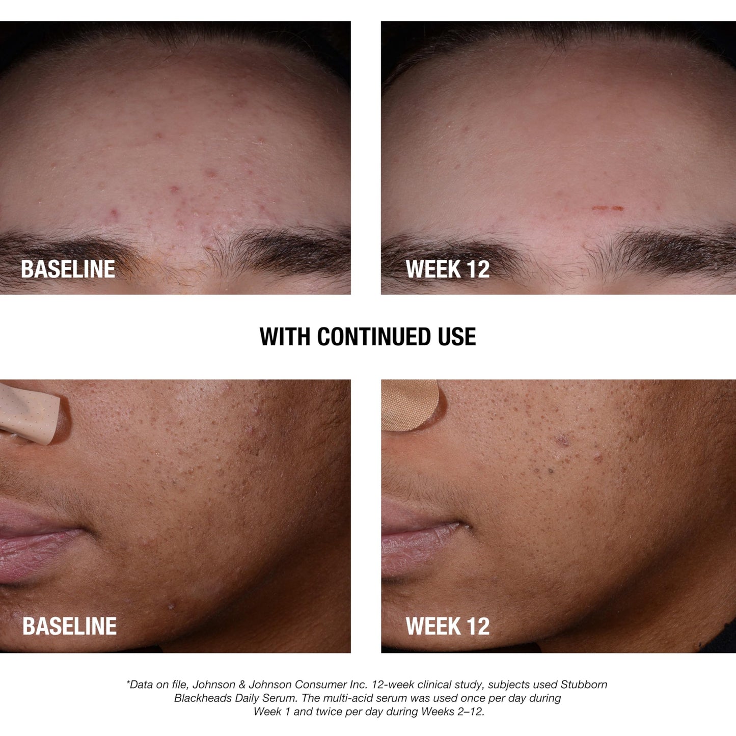 Neutrogena Stubborn Blackheads Daily Acne Serum with Salicylic, Glycolic, Polyhydroxy & Mandelic Acids, Oil-Free Face Serum, 1 fl. oz