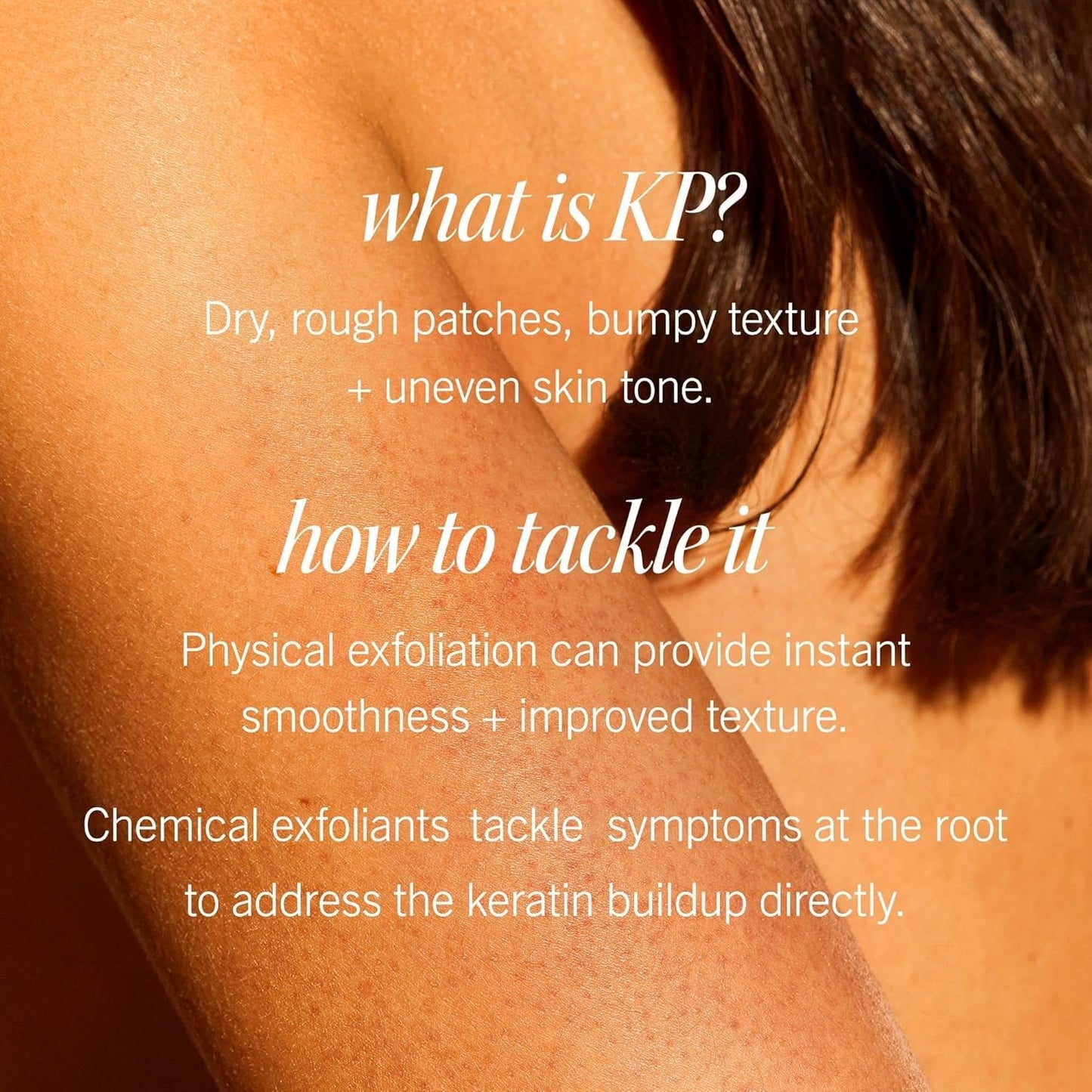 First Aid Beauty KP Bump Eraser Body Scrub 10% AHA – Exfoliates & Smooths Chicken Skin Bumps, Glycolic & Lactic Acid, Sensitive Skin Safe, 8oz 2-Pack