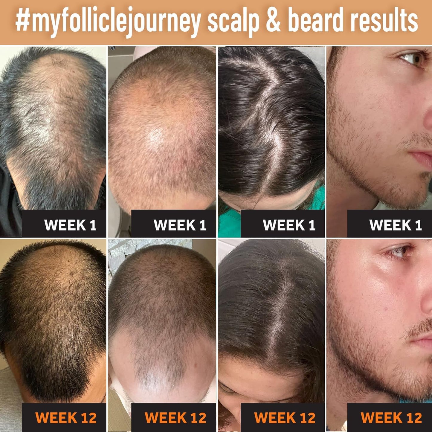 Biotin Hair Growth Conditioner for Men & Women – Natural DHT Blocker with Caffeine, Saw Palmetto, Niacin & Zinc – Thickens & Strengthens Hair