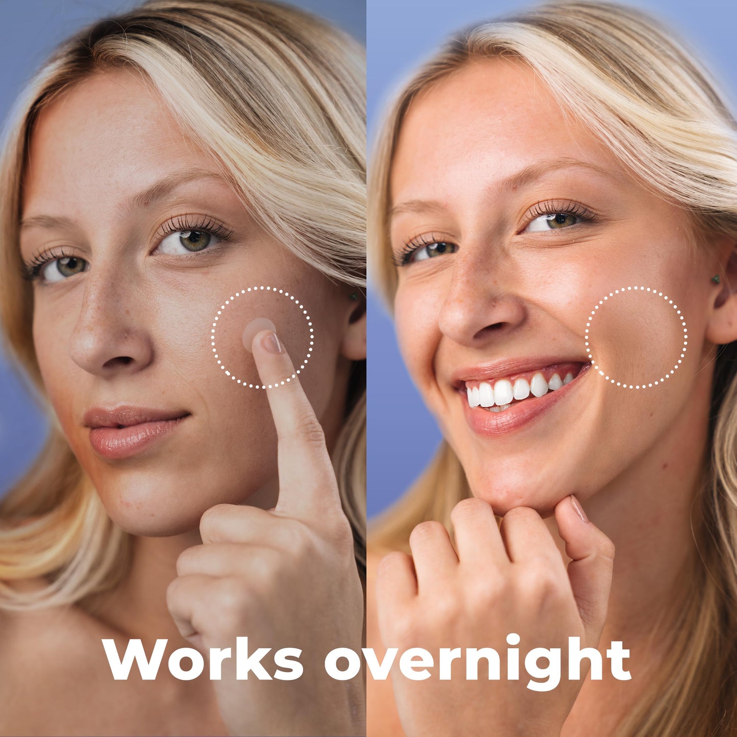 PatchRx Salicylic Acne Patches with Tea Tree Oil, 120 Pack – Zit & Pimple Stickers for Face Skincare, Salicylic Acid Dots