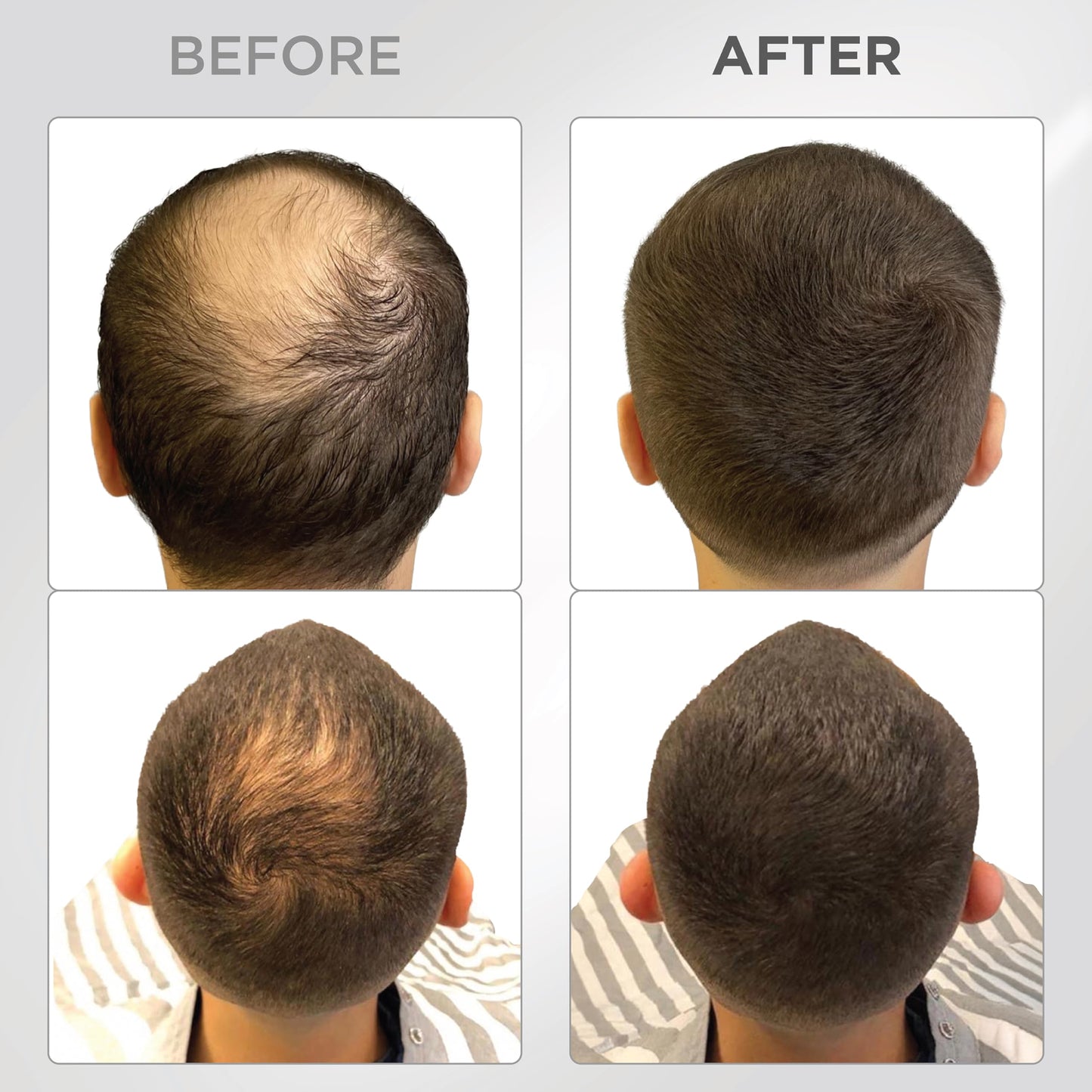 THICK FIBER Hair Fibers for Thinning Hair & Bald spots (DARK BROWN) - 25g Bottle - Conceals Hair Loss in Seconds - Hair Powder for Women & Men