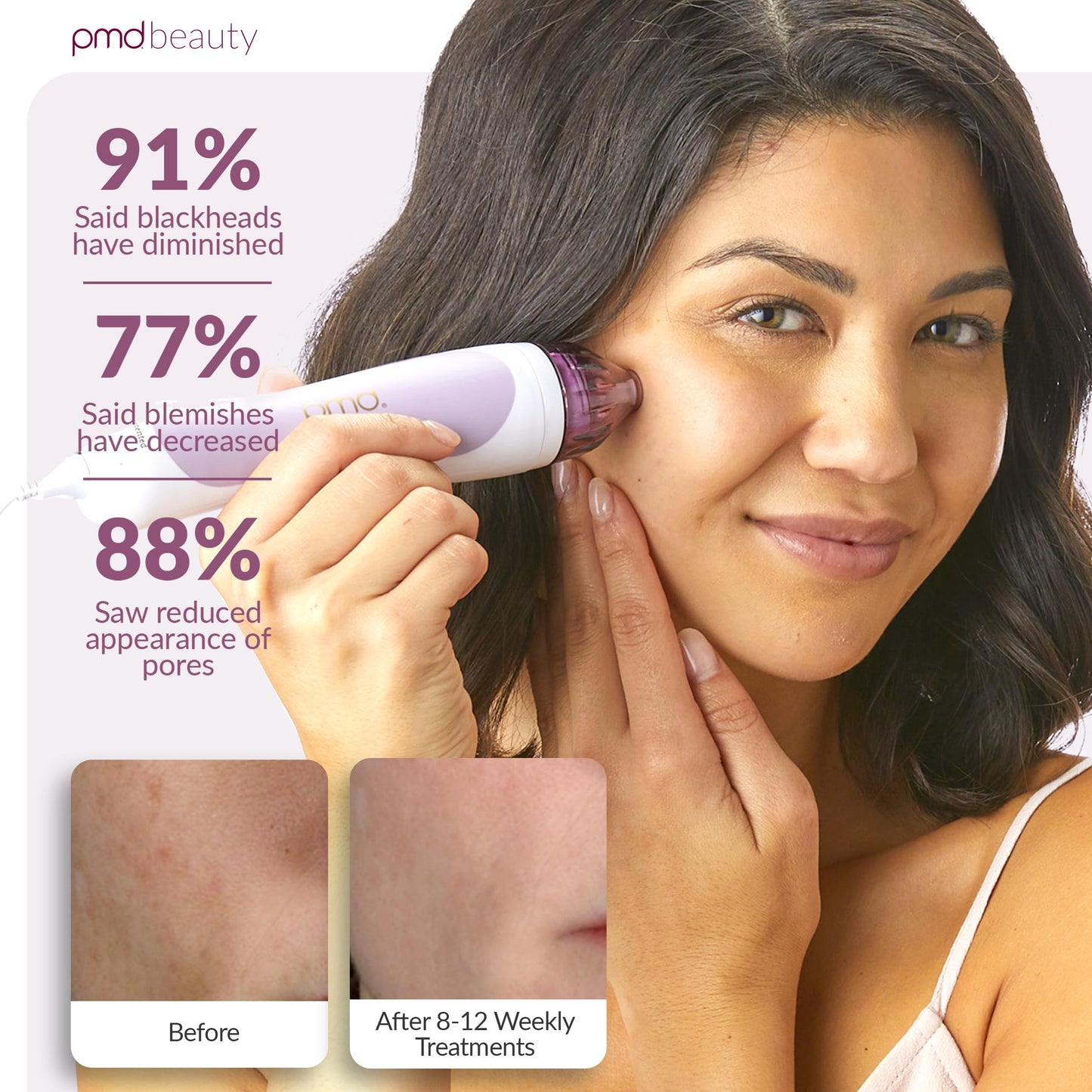 PMD Personal Microderm Classic for At-Home Use, Facial Exfoliator Tool, Microdermabrasion Machine Kit for Face and Body Skincare, Lavender