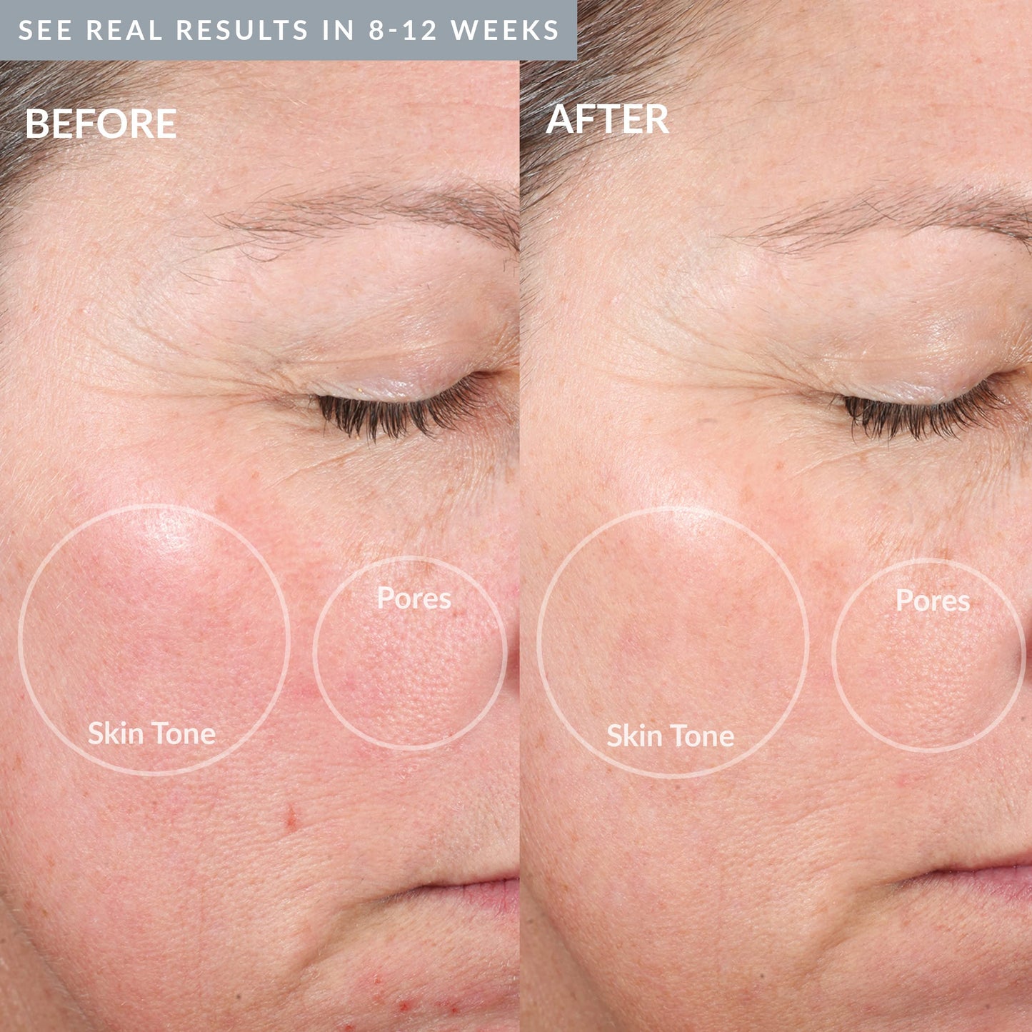 PMD Personal Microderm Elite Pro – At-Home Microdermabrasion Kit for Face & Body with Exfoliating Crystals, Vacuum Suction & 3 Speeds