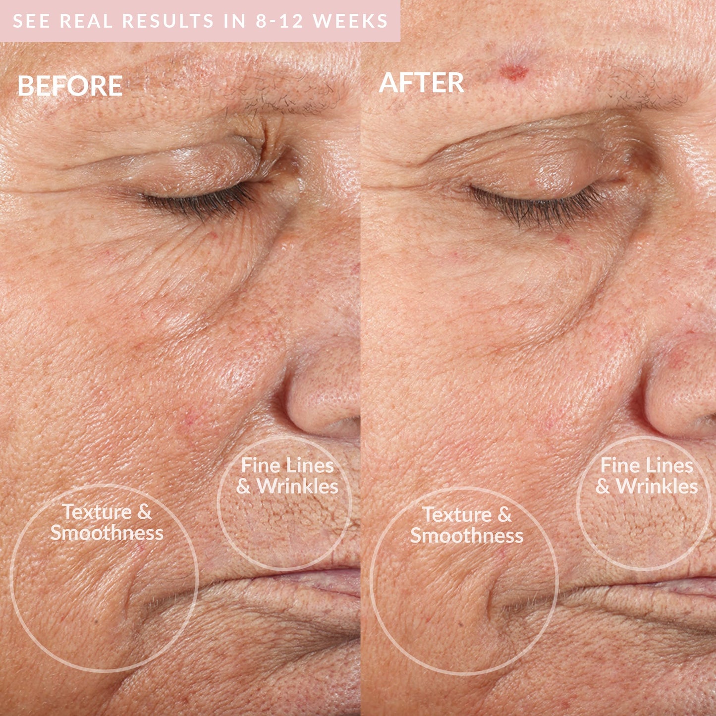 PMD Personal Microderm Classic – At-Home Microdermabrasion Kit for Face & Body, Exfoliator Tool with Recovery Mask & Blush